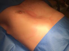 Nuss procedure Image5