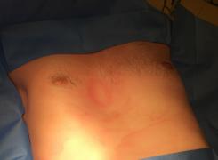 Nuss procedure Image4