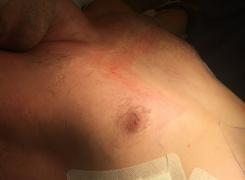 Nuss procedure Image3