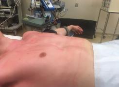 Nuss procedure Image2