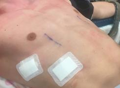 Nuss procedure Image1